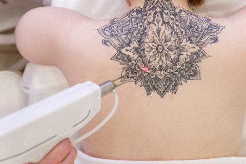 rimozione tatuaggi milano CDI centro diagnostico